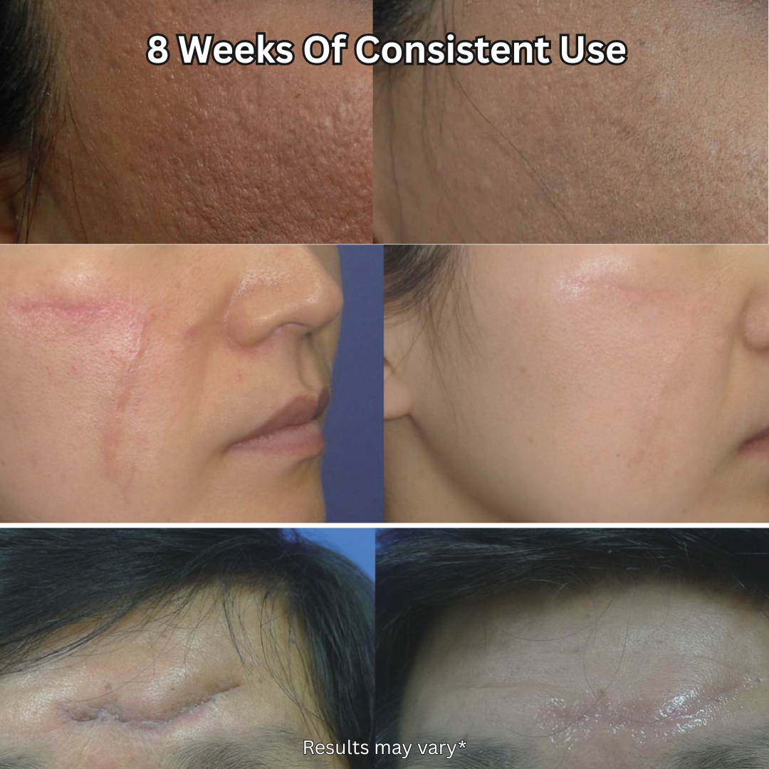 Renewsil™ Silicone Scar Stick