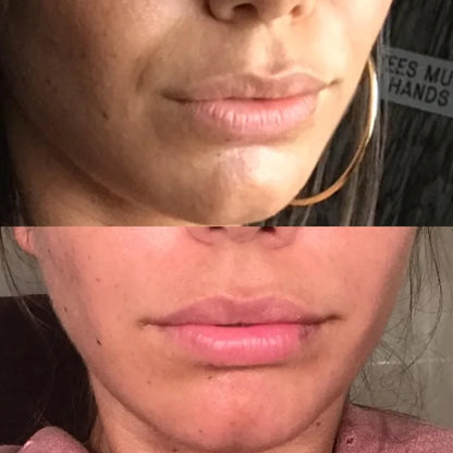 Renewsil™ Silicone Scar Stick